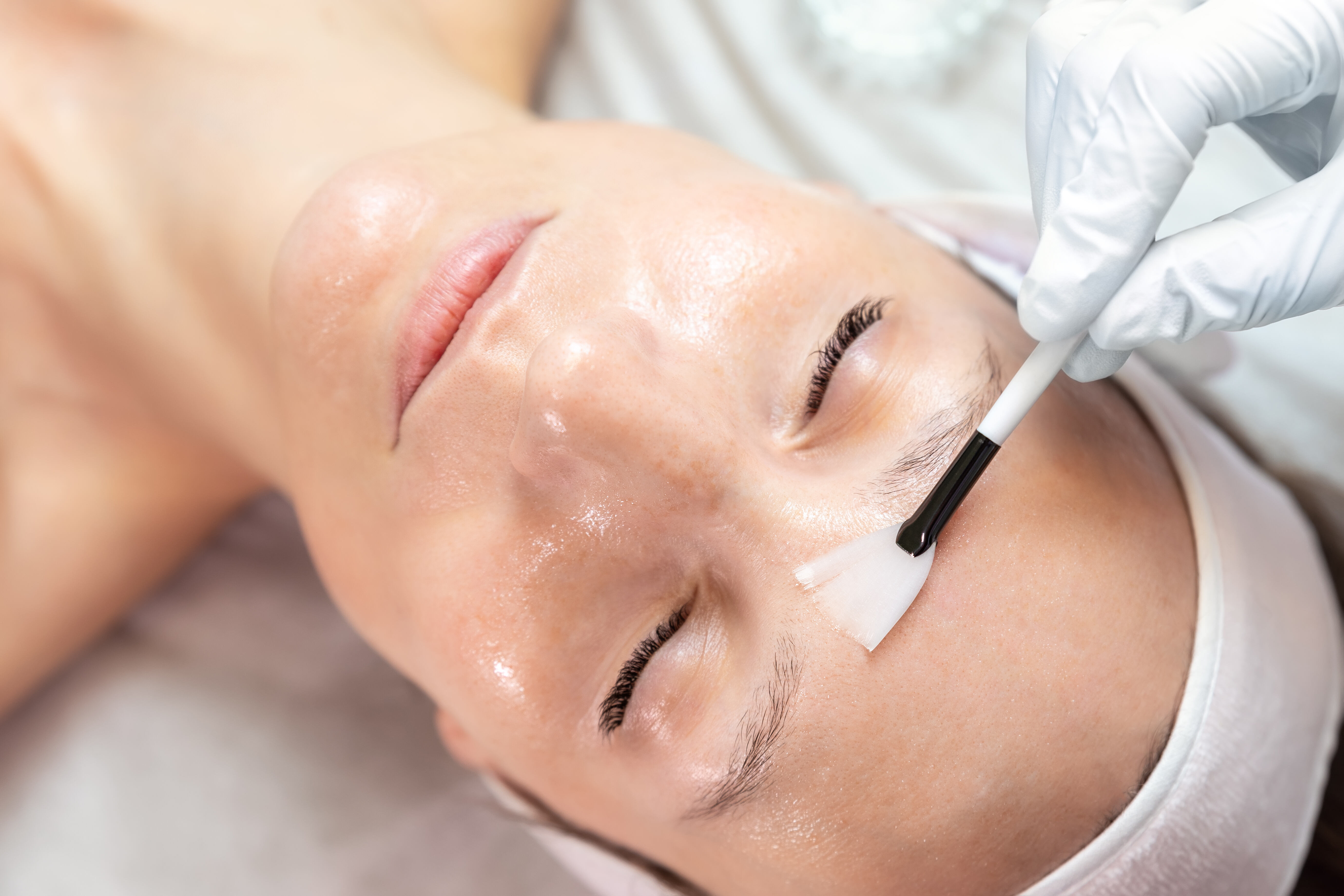 What is skin peeling treatment ?