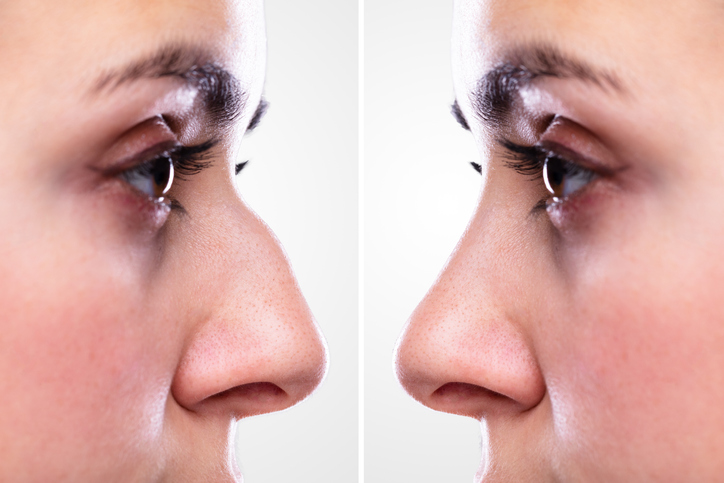 Navigating Rhinoplasty: What to Expect Before, During, and After Surgery