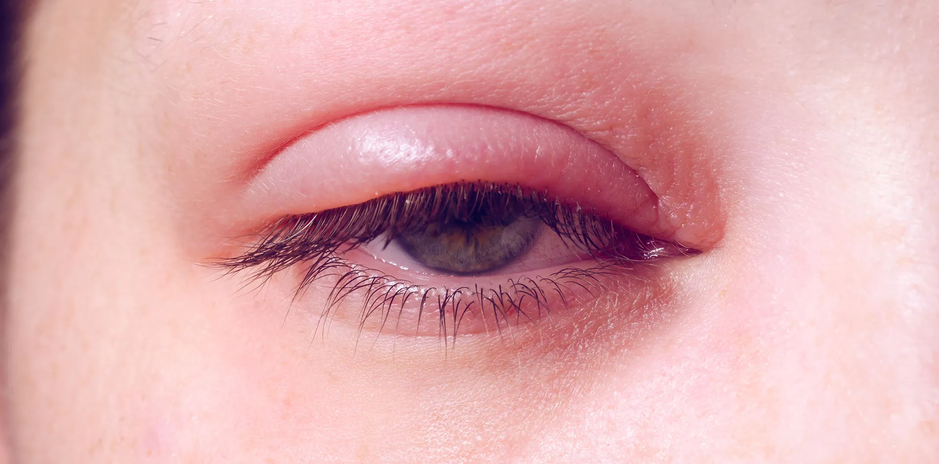 Causes of Puffy Eye, eye stye, thyroid eye disease