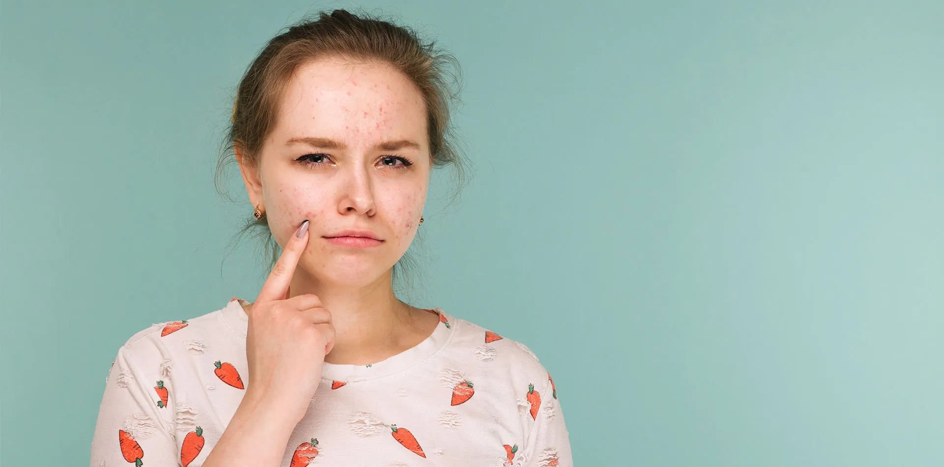 Acne Scars | All You Need to Know | American Hospital Dubai